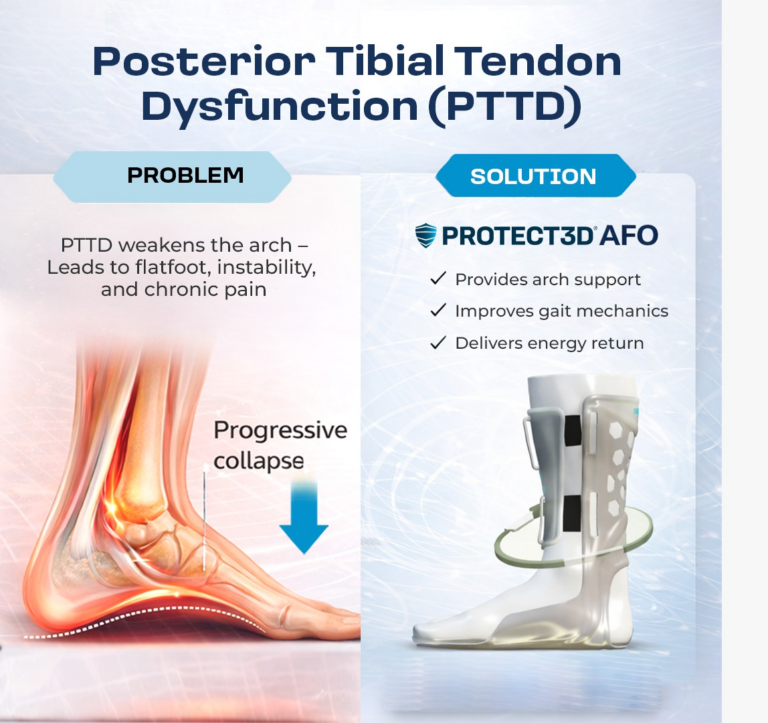 AFO for PTTD. Ankle foot orthotic for posterior tibial Tendon Dysfunction